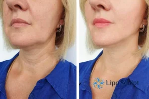 Double chin before and after Hi-Fu treatment 4 Book your double chin treatment Aylestone today! We are here to help!