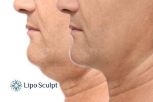 Double chin before and after Hi-Fu treatment 2 Double chin treatment Aylestone from Lipo Sculpt - feel more confident today!