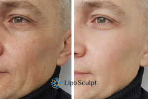 How to Fight Aging Symptoms 3 Fight Aging Symptoms Aylestone With HIFU and Morpheus8 Today!