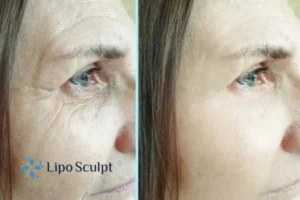 How to Fight Aging Symptoms 2 Do you want to Fight Aging Symptoms Aylestone? Contact Lipo Sculpt today!