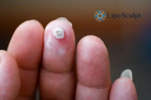 Cryopen Top 5 Treatable Conditions 4 Do you have a persistent wart of verruca that you cannot shit? Cryopen Aylestone treatment will work call us NOW!