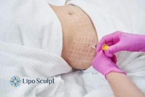 Are The Results From Aqualyx Permanent? 1 Do you want to know how long Aqualyx Aylestone results last?