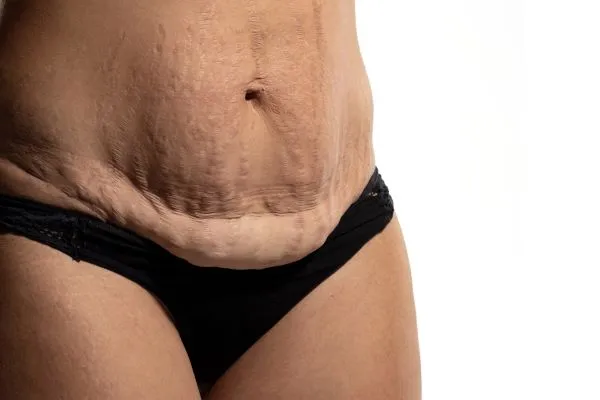 Lost the Weight but Not the Loose Skin? 1 image of womans stomach after weight loss showing loose skin Aylestone